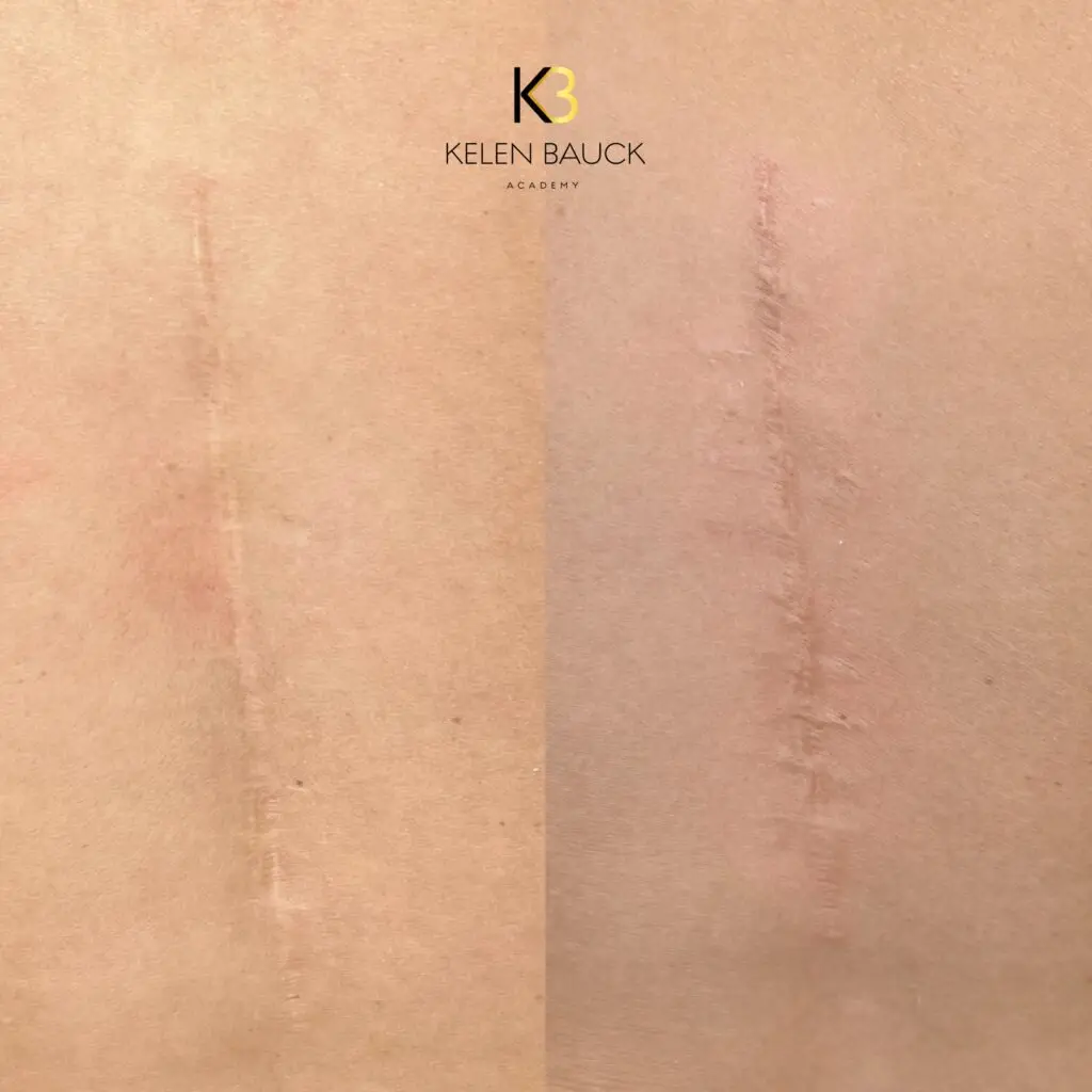 Avant après d'une cicatrice camouflée grâce à la nano pigmentation. Camouflage efficace des cicatrices avec la méthode Nano Pigmentation V Gloweffectué à Kanea Tattoo & Beauty à Toulon.