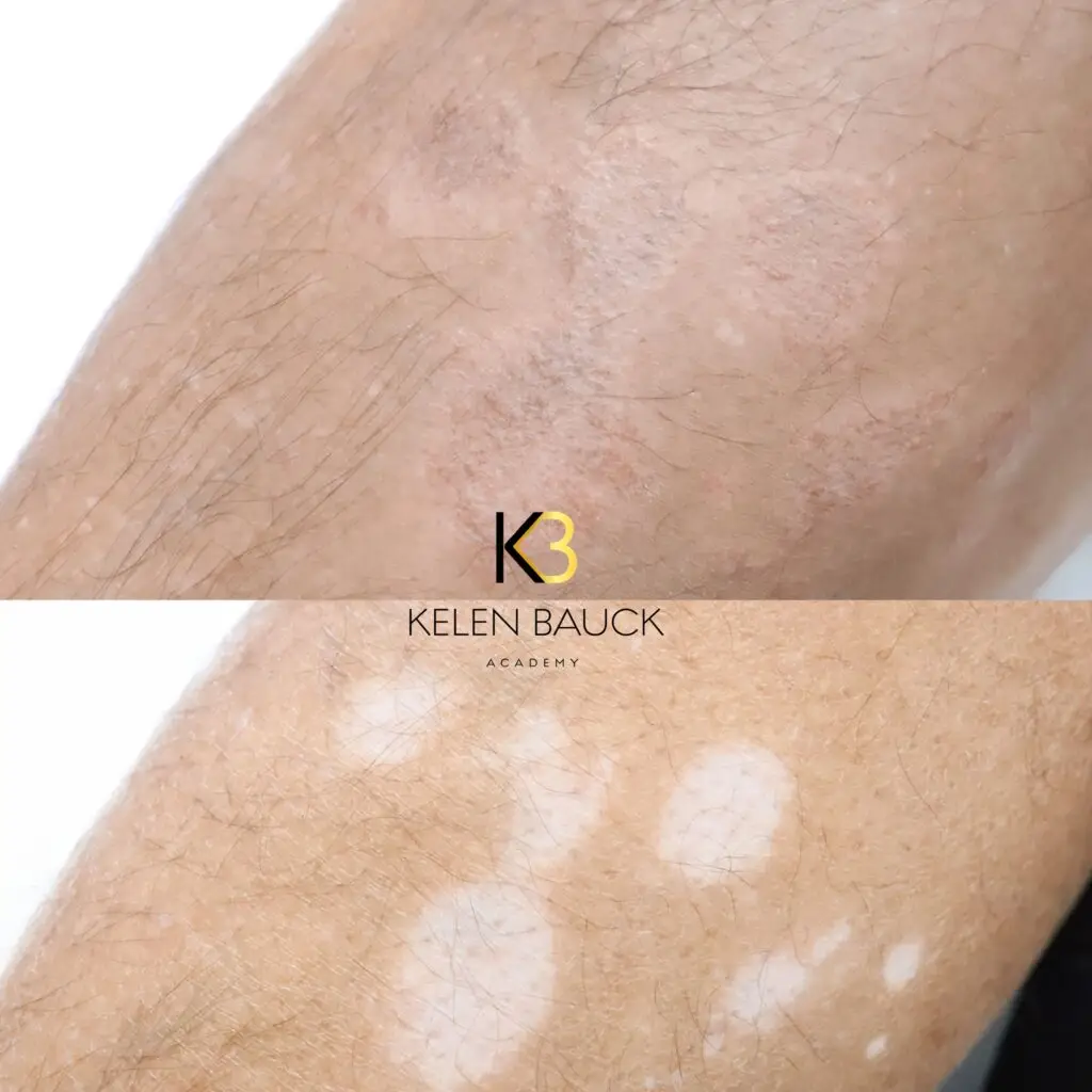 Avant/après d'une peau atteinte de vitiligo, repigmentée grâce à la nano pigmentation à Kanea Tattoo & Beauty à Toulon.