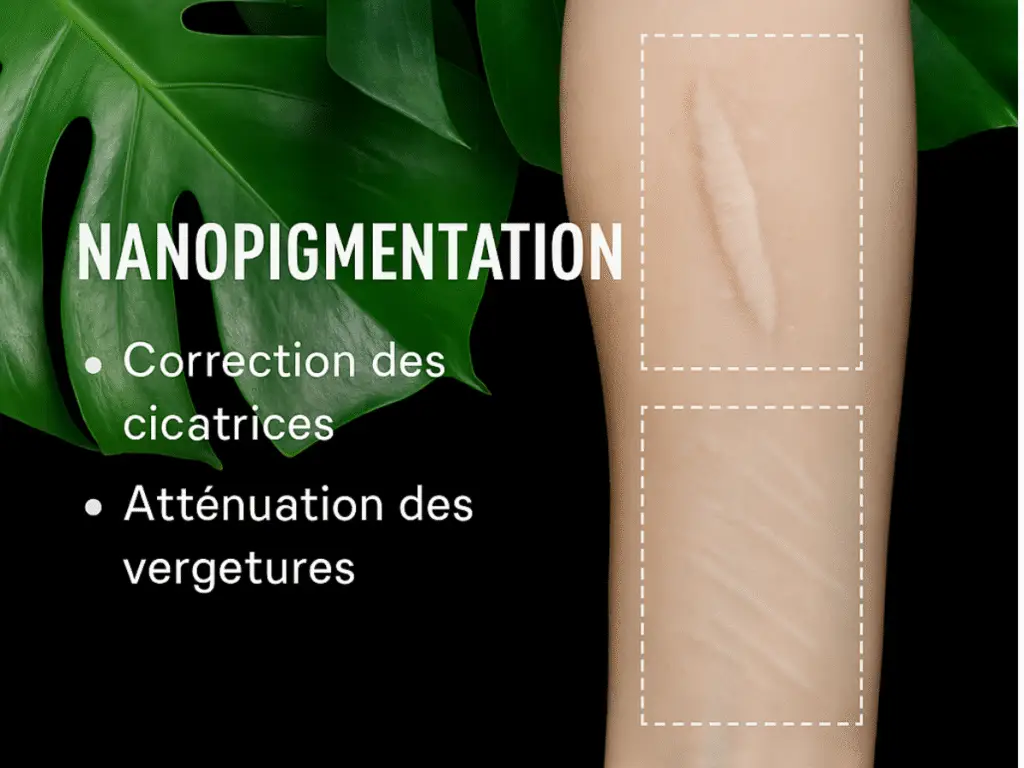 Résultat de nanopigmentation sur cicatrices et vergetures à Toulon chez Kanea Tattoo & Beauty