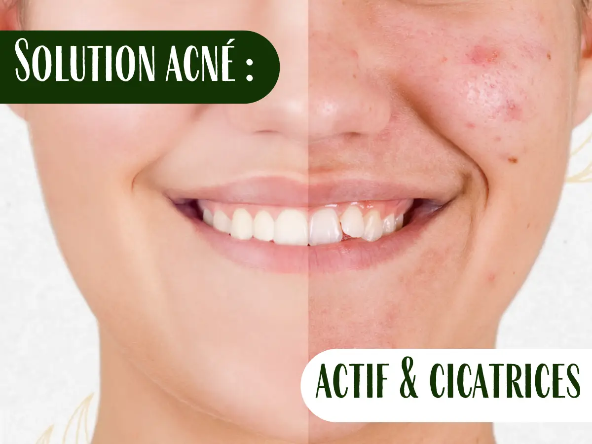 Plasma russe acné Toulon – Résultat avant/après d’un soin esthétique contre l’acné chez Kanea Tattoo & Beauty.