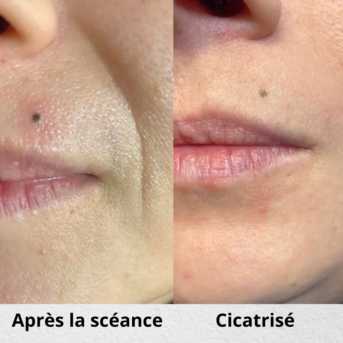 Dermopigmentation grain de beauté à Toulon : recréation d'un grain de beauté disparu (chirurgie, cicatrice) ou ajout, au dermographe, pigments médicaux Biotic Phocéa