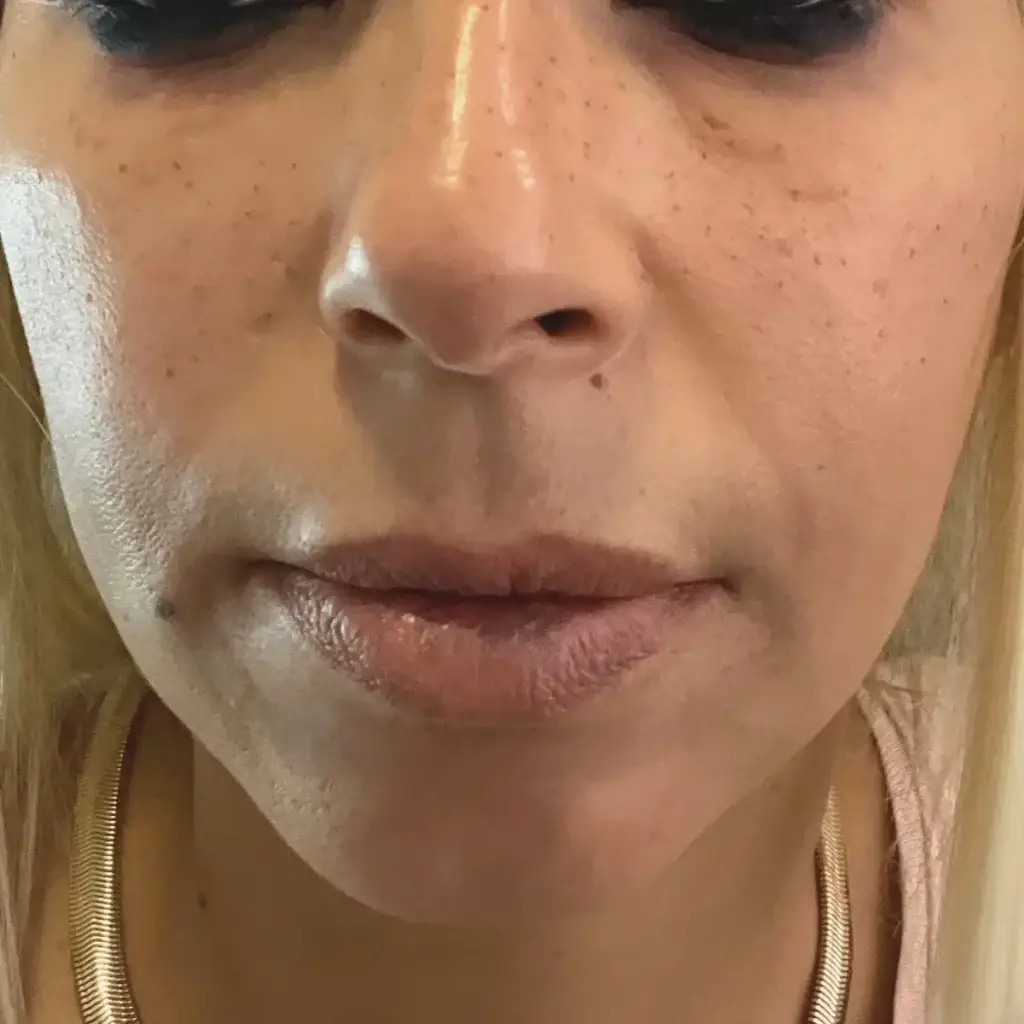 Dermopigmentation taches de rousseur sur le nez et les pommettes à Toulon : pigments dilués au dermographe, rendu naturel et léger, technique sur-mesure