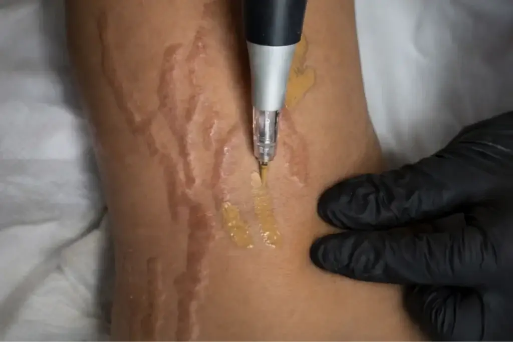 Nano-pigmentation d'une cicatrice en relief sur l'avant-bras réalisée à Toulon, dermographe et gel de travail