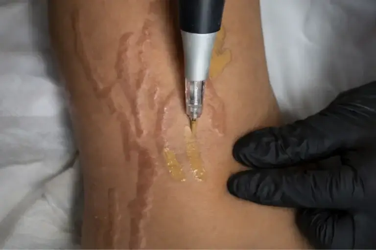 Nano-pigmentation d'une cicatrice en relief sur l'avant-bras realisee a Toulon, dermographe et gel de travail