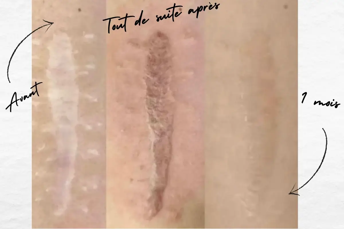 Triptyque avant tout de suite apres et 1 mois apres une nano-pigmentation de cicatrice realisee a Toulon