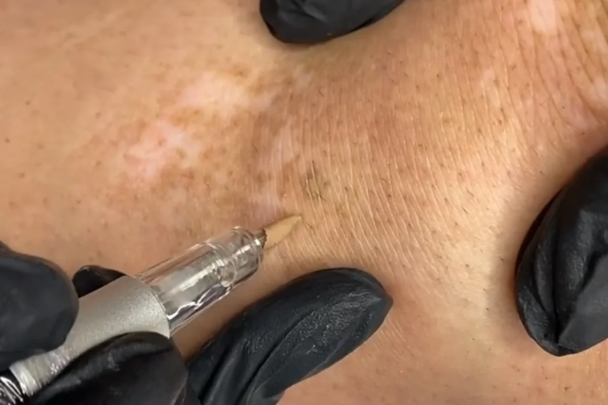 Travail au dermographe nano-pigmentation sur peau du dos avec taches pigmentaires, salon a Toulon Var