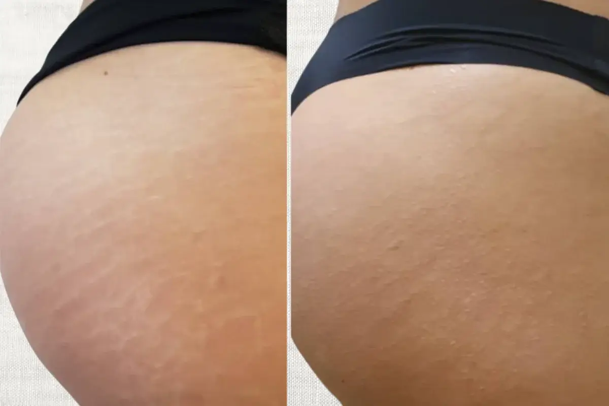Avant apres d'une nano-pigmentation de vergetures blanches sur les fesses realisee au salon Kanea a Toulon
