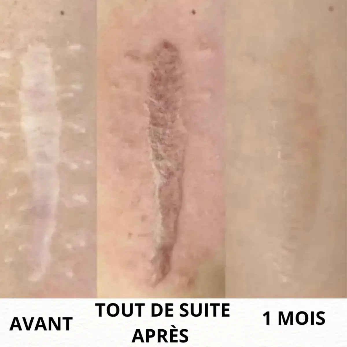 Camouflage d'une cicatrice en nanopigmentation, Toulon