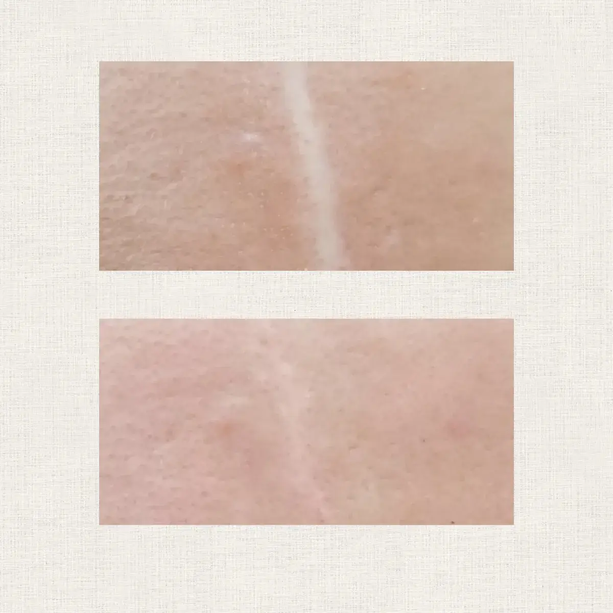 Cicatrices Kanea Toulon