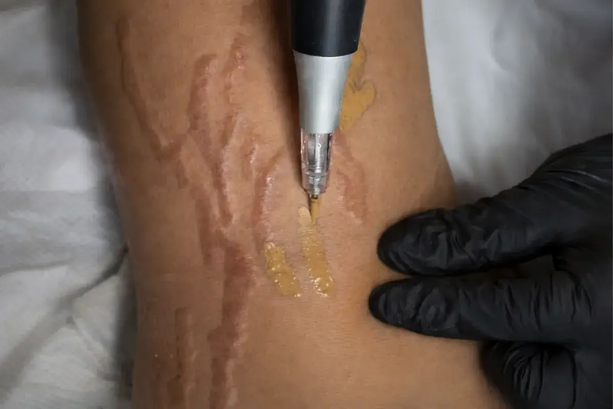 Nano-pigmentation de cicatrices sur cliente, resultat avant-apres au salon Kanea, Toulon