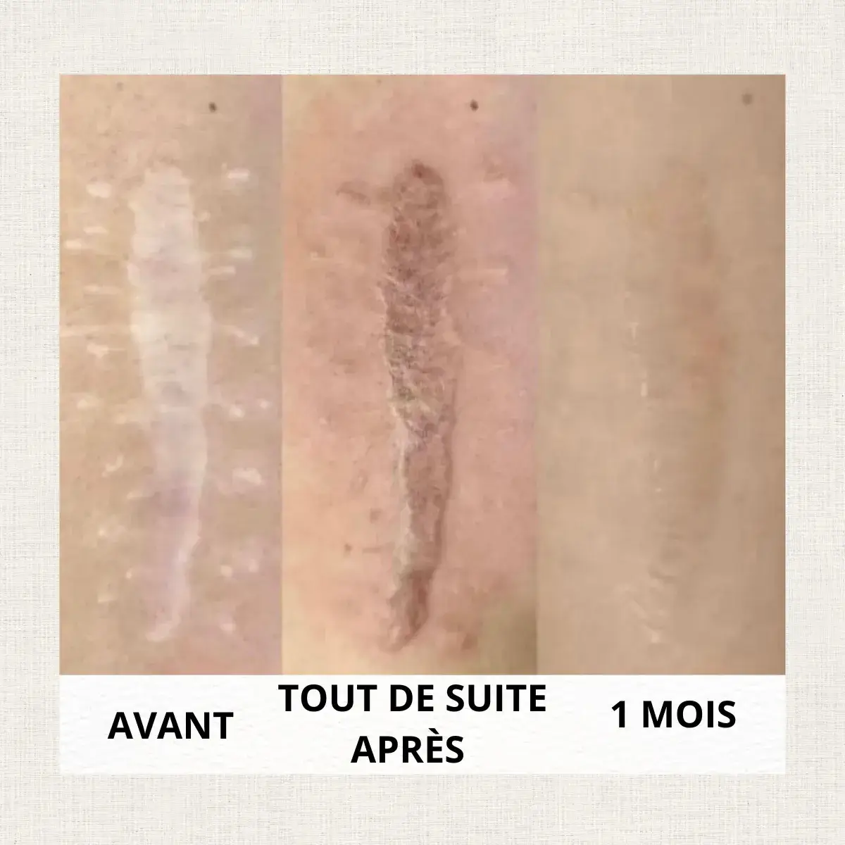 Portfolio nanopigmentation Kanea Toulon