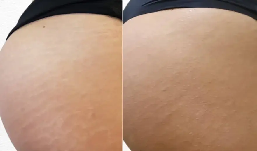 Nanopigmentation vergetures blanches sur la cuisse à Toulon : camouflage par pigments adaptés à la carnation, méthode VGlow Kelen Bauck