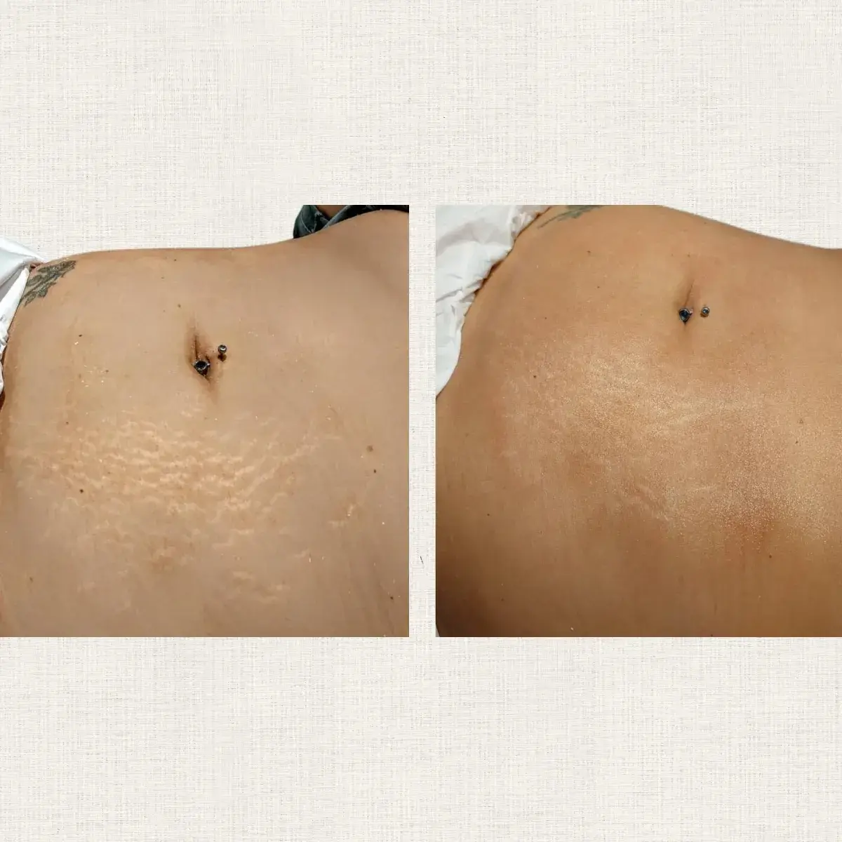 Portfolio nanopigmentation Kanea Toulon