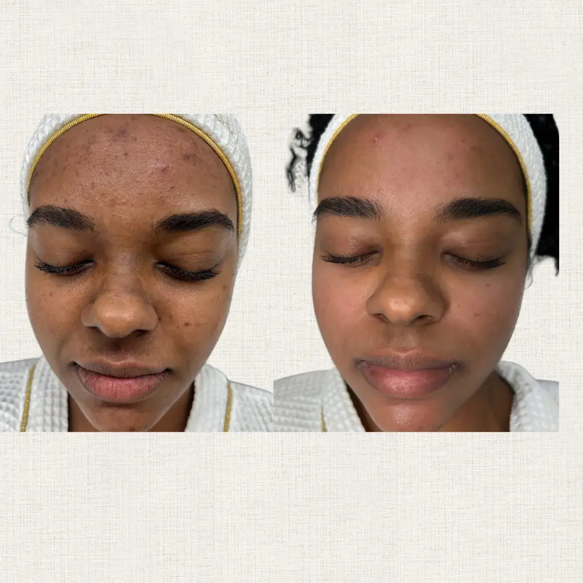 Acné — avant/après Kanea Toulon