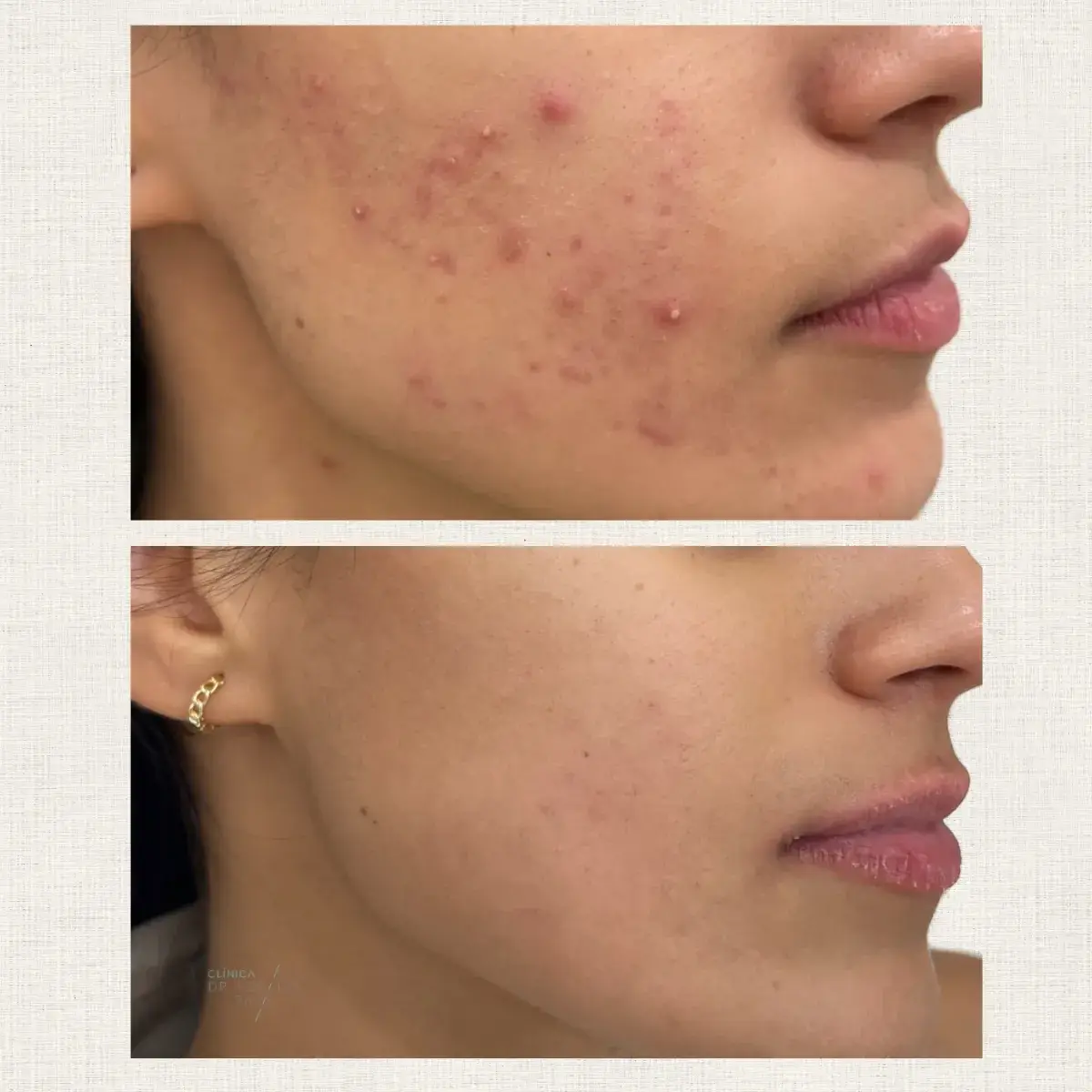 Portfolio peeling Kanea Toulon