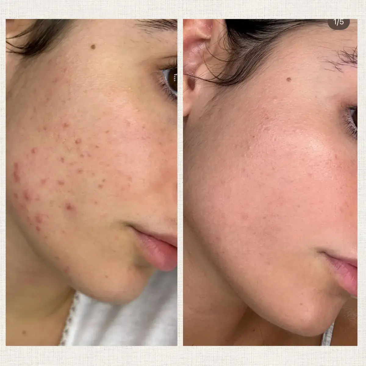 Portfolio peeling Kanea Toulon