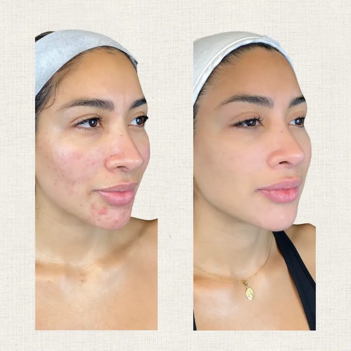 Portfolio peeling Kanea Toulon