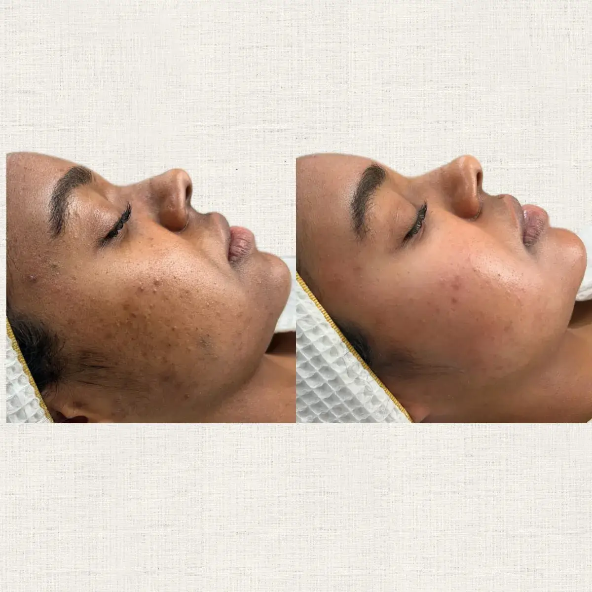 Cicatrices acné Kanea Toulon