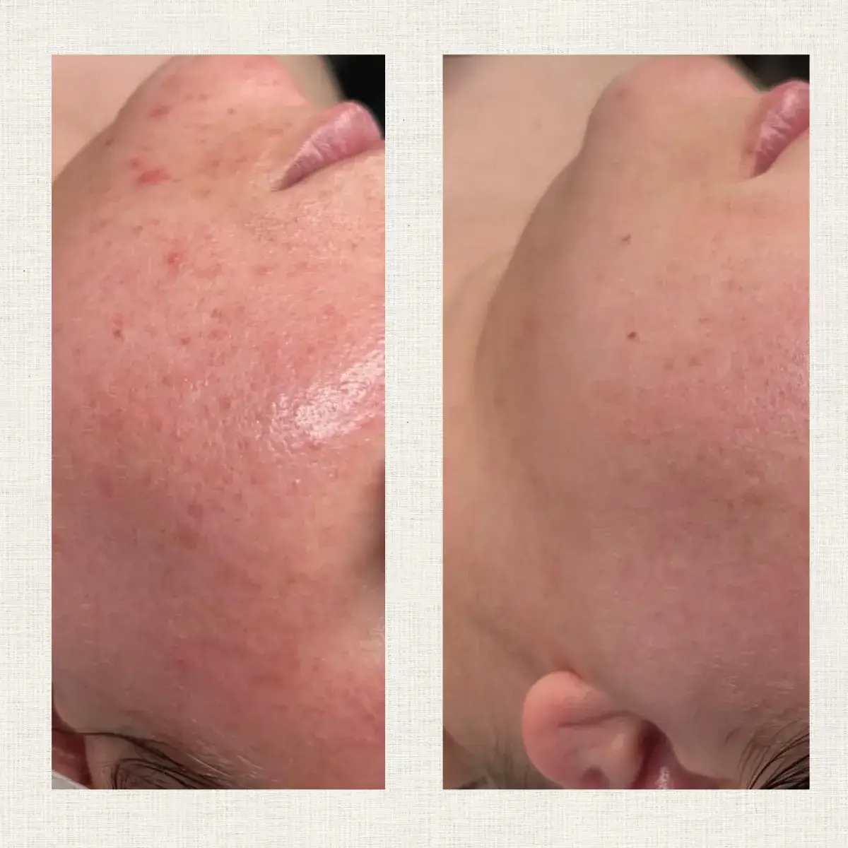 Portfolio peeling Kanea Toulon