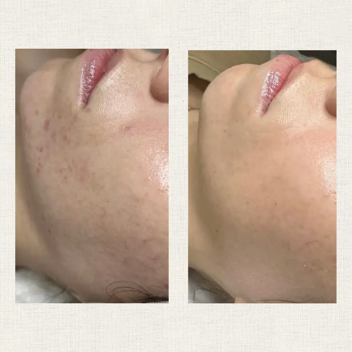 Portfolio peeling Kanea Toulon