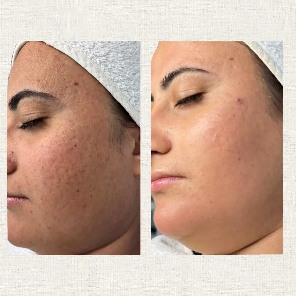 Quel peeling choisir pour ta peau