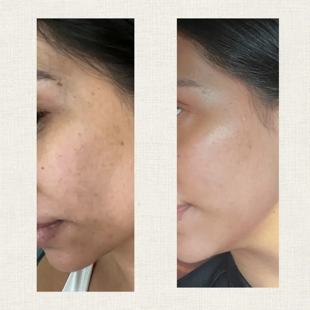 Tâche pigmentaire Kanea Toulon