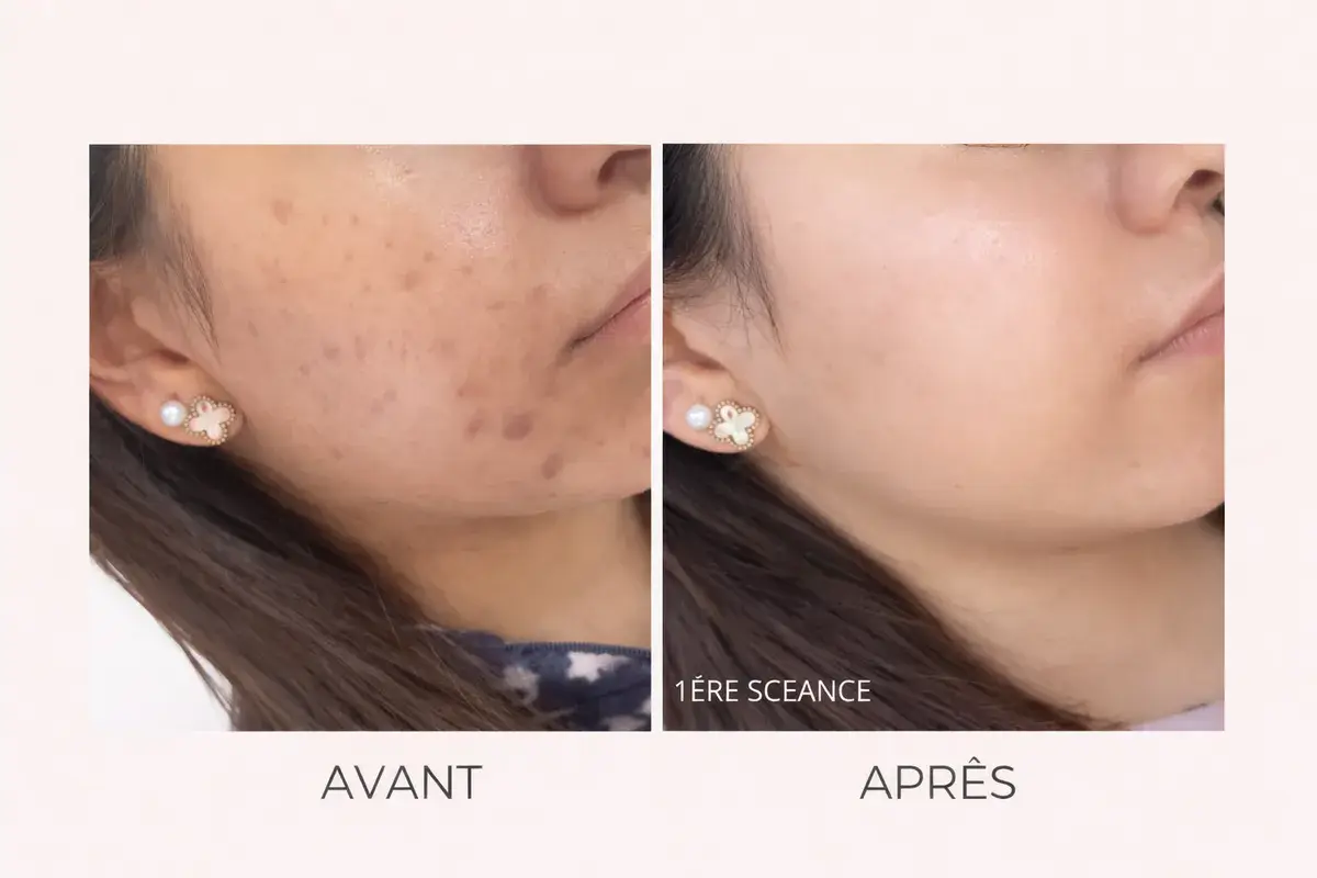 Peeling naturel acné résultat avant après - Toulon