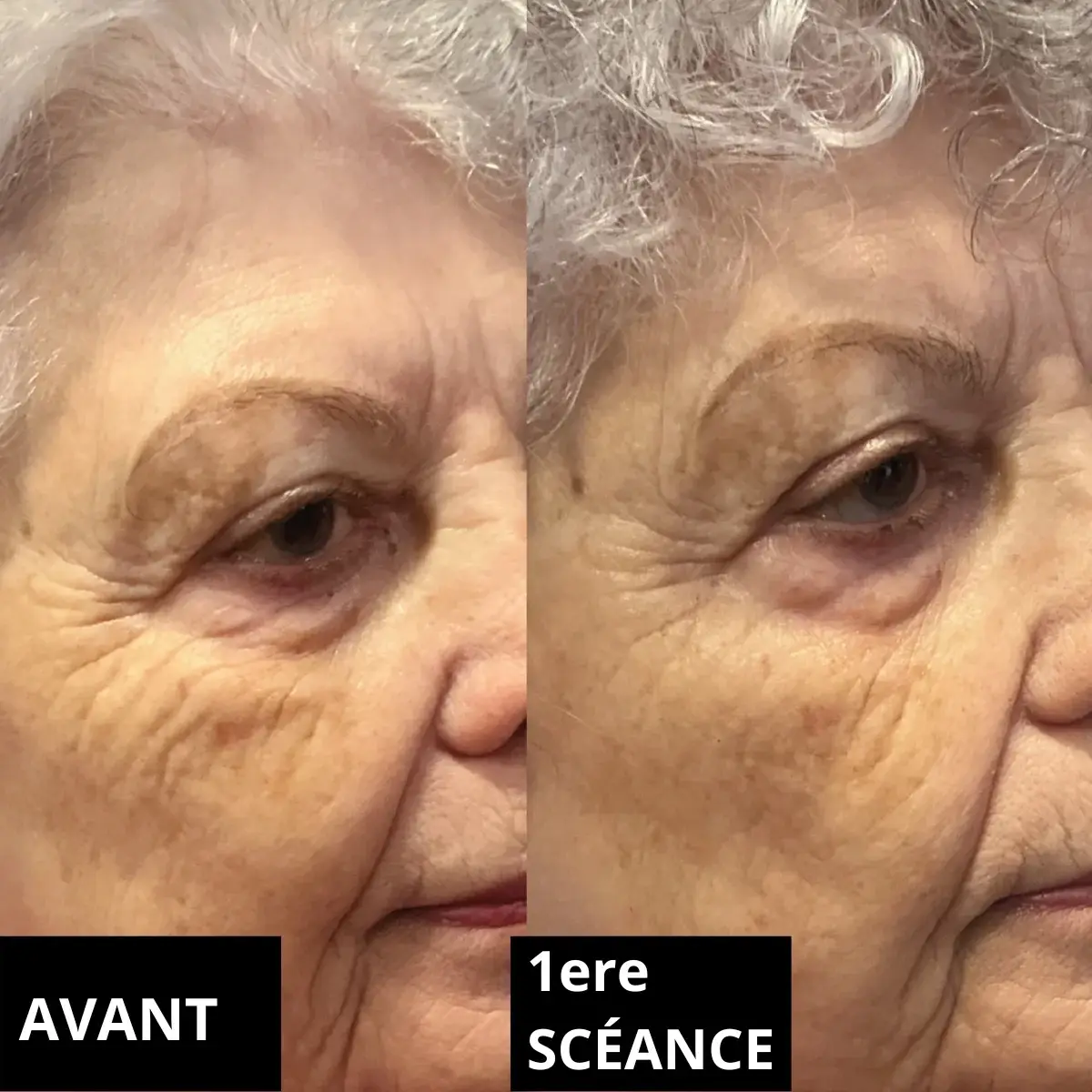 Avant/après plasma froid russe sur le visage à Toulon : raffermissement, réduction des rides, soin non invasif sans chirurgie