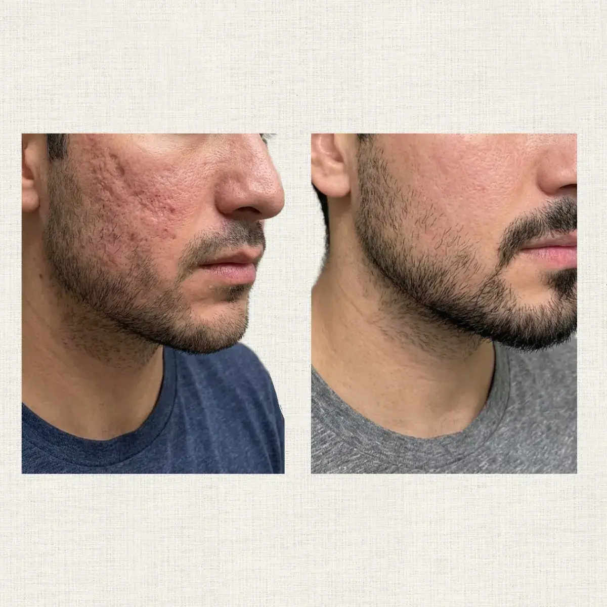 Cicatrices acné Kanea Toulon