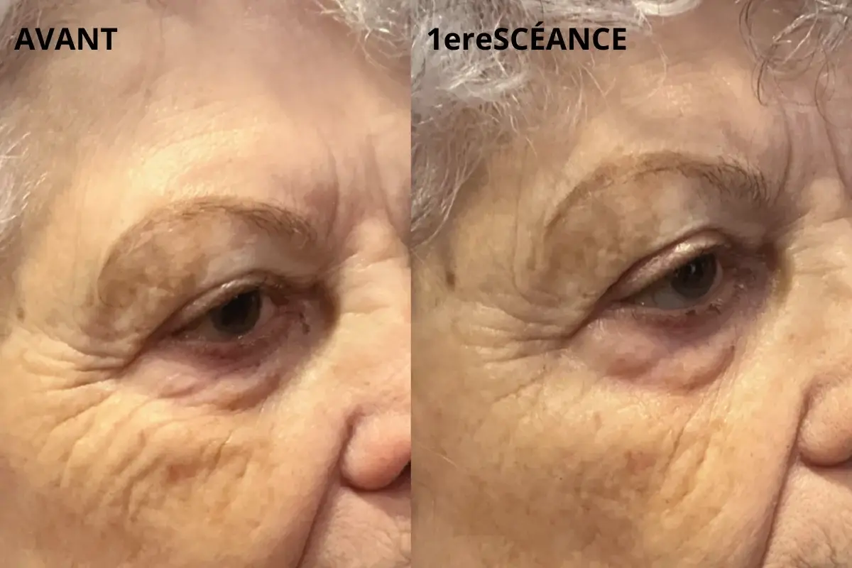 Plasma froid contour des yeux avant après, paupières à Toulon