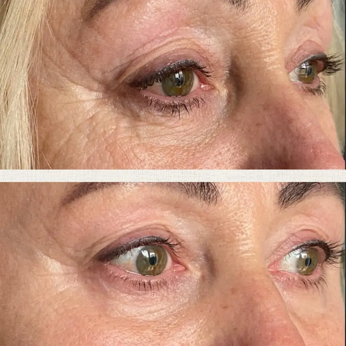 Paupières tombantes Kanea Toulon