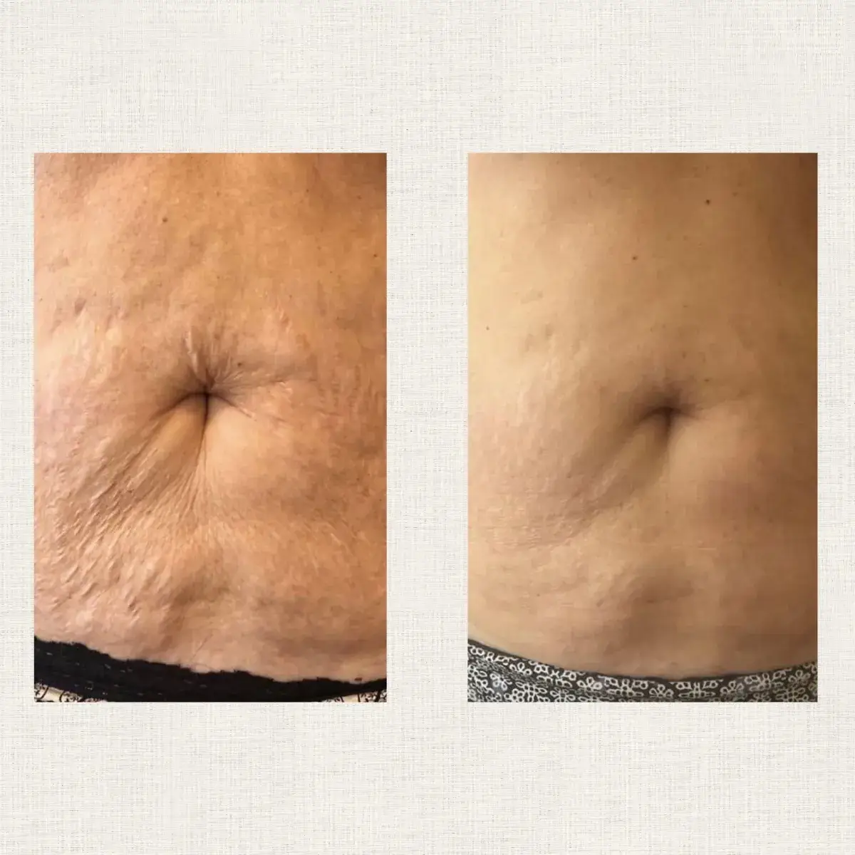 Raffermissement Kanea Toulon