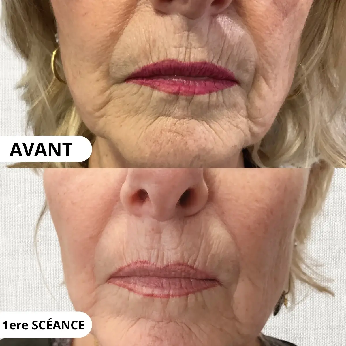 Plasma froid russe résultat sur les rides à Toulon : peau raffermie, texture améliorée, soin anti-âge naturel