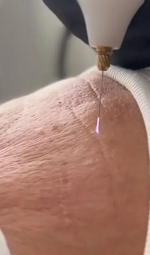 Traitement des rides du front par plasma froid au salon Kanea Beauty à Toulon — machine plasma visible sur la peau, séance réalisée par Karine, praticienne avec 25 ans d'expérience. Soin non invasif qui stimule le collagène sans chirurgie ni injection.