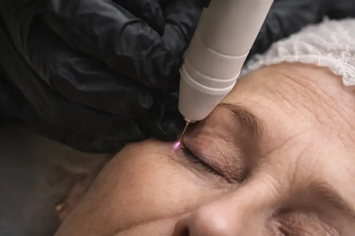 Plasma russe en action sur le visage d'une cliente, soin esthetique au salon Kanea Toulon