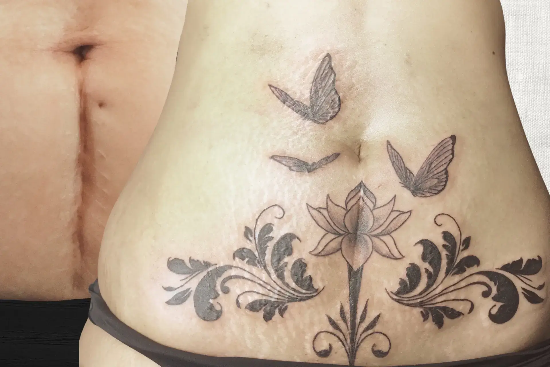 Tatouage floral posé sur une cicatrice du ventre, studio Kanea à Toulon