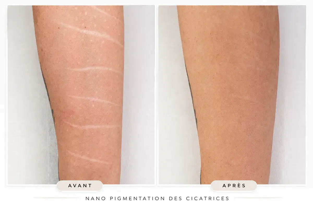 Nanopigmentation de cicatrices sur l'avant-bras, Toulon