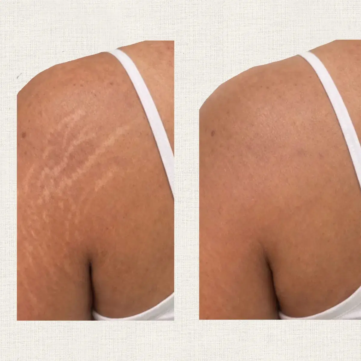 Nano-pigmentation de vergetures en camouflage haute précision résultat Toulon Kanea
