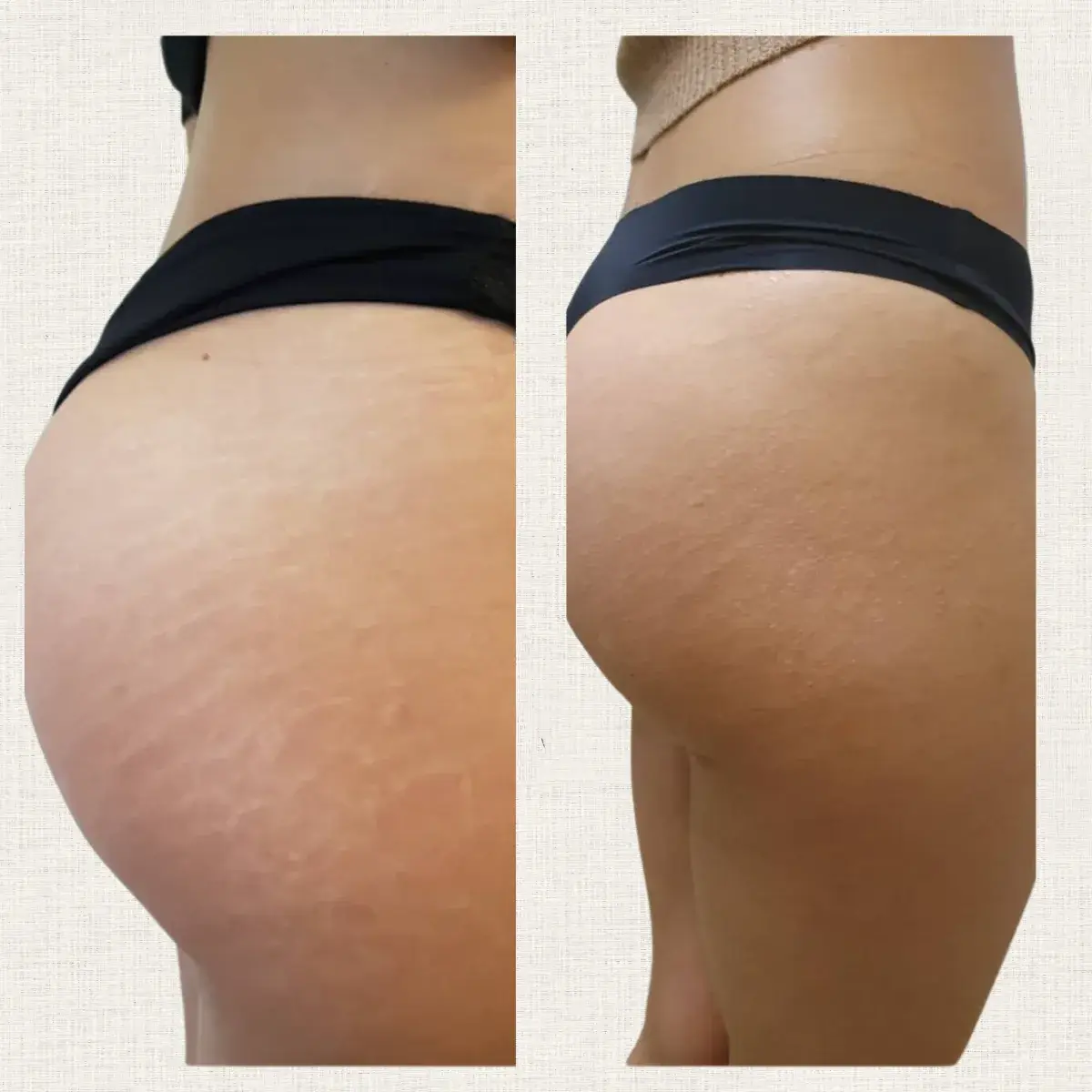 Détail du résultat de nano-pigmentation sur vergetures à Toulon chez Kanea