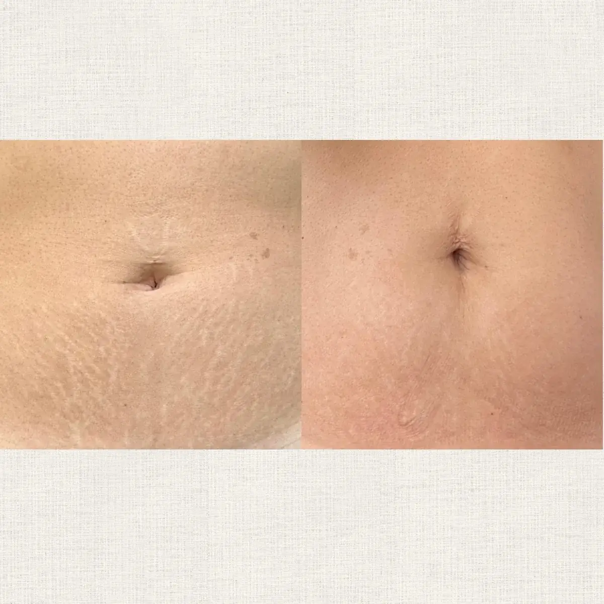 Avant après nano-pigmentation sur vergetures camouflage à Toulon chez Kanea