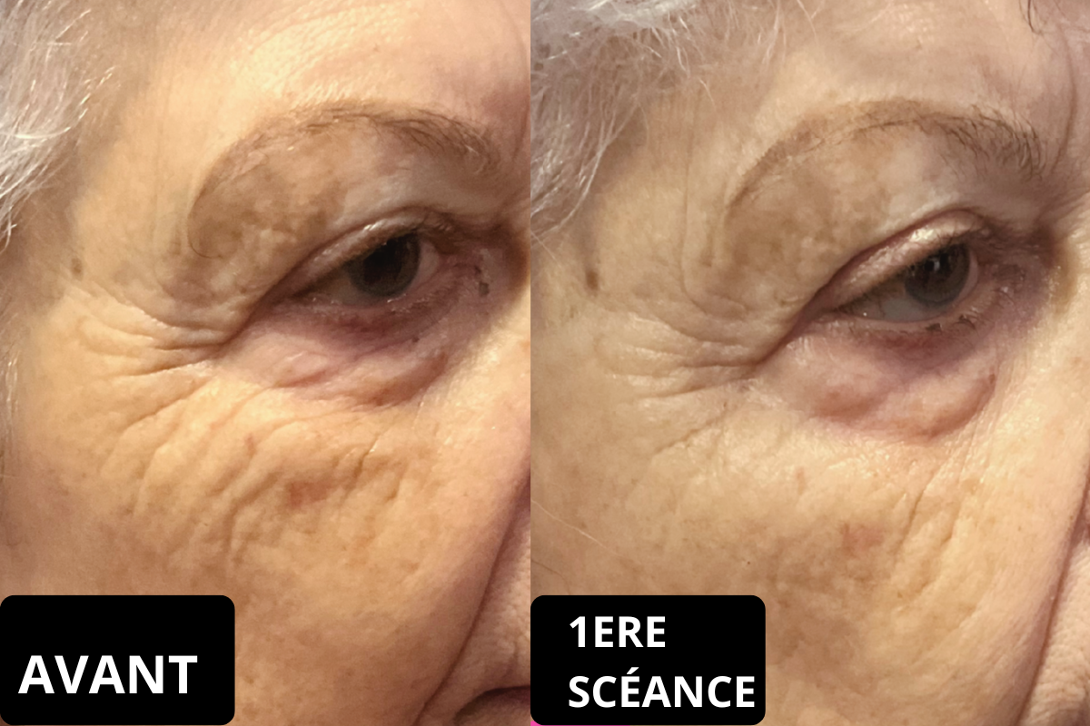 Resultat plasma froid anti-rides contour des yeux avant apres au salon Kanea a Toulon