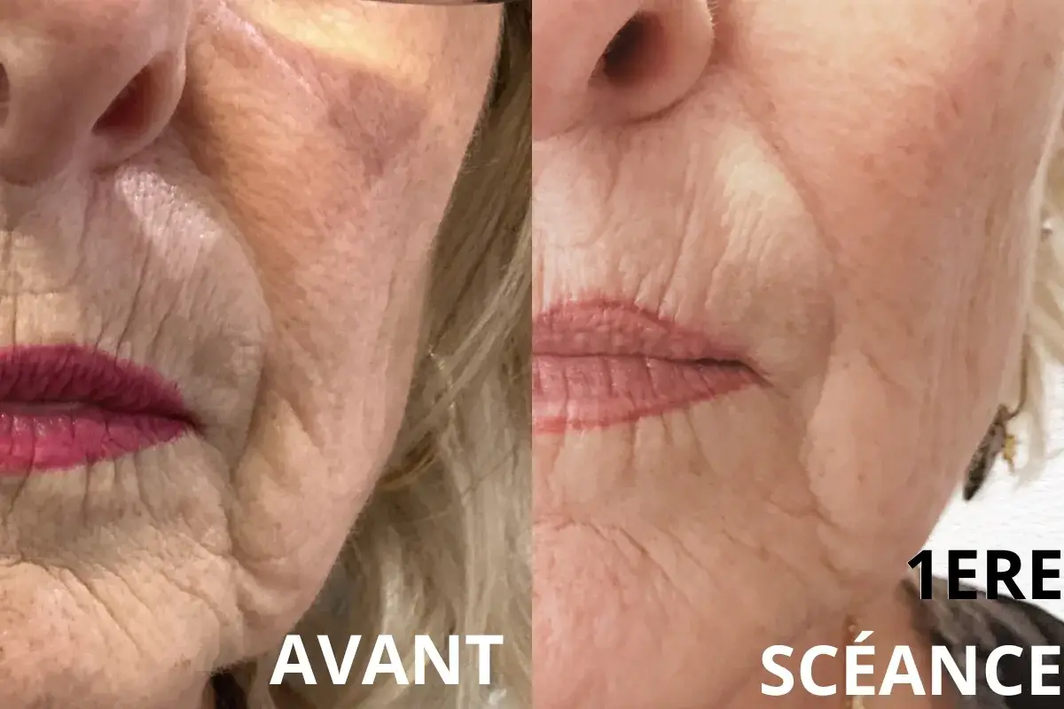 Plasma froid sur le bas du visage, avant après, à Toulon