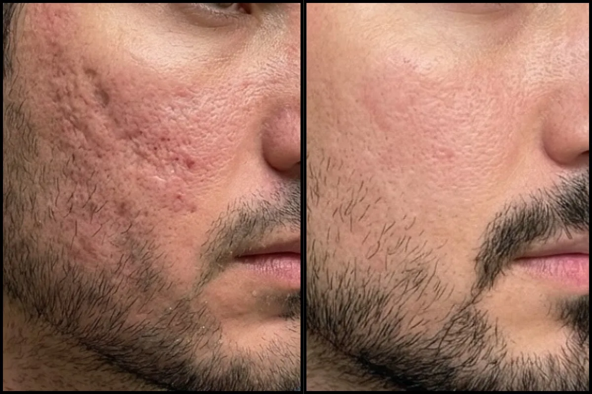Avant après plasma froid sur cicatrices d'acné du visage chez un homme à Toulon Kanea
