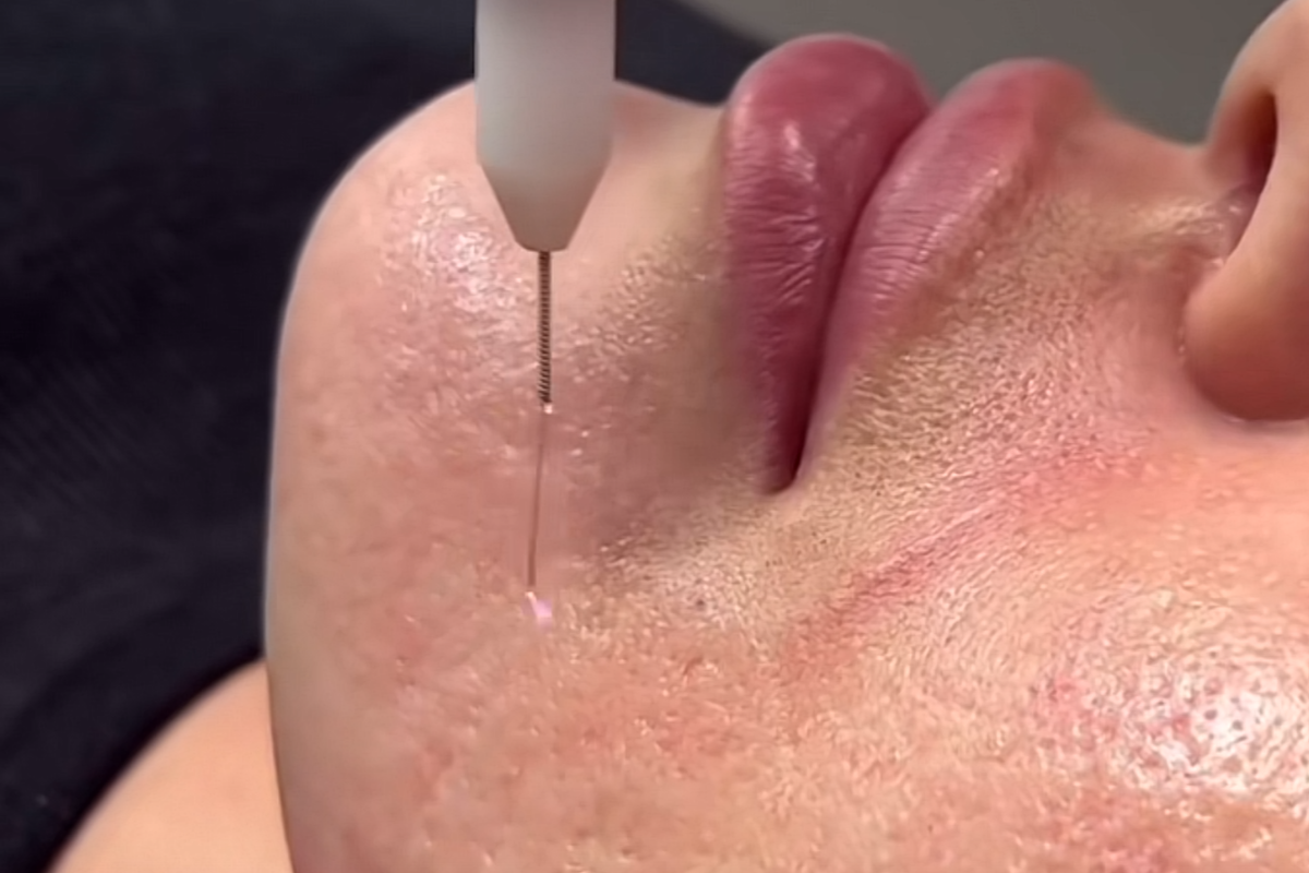 Seance de plasma froid en action sur une cliente au salon Kanea Tattoo & Beauty a Toulon