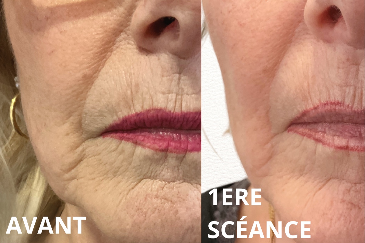 Resultat plasma froid avant apres cote droit du visage - salon Kanea Tattoo & Beauty Toulon