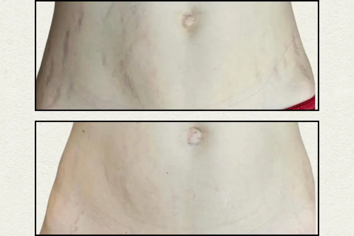 Avant après plasma froid sur vergetures du ventre chez une femme à Toulon Kanea