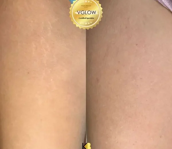 Avant / après de camouflage de vergetures sur une cuisse avec la nano pigmentation V glow à Toulon - Résultats avant-après
