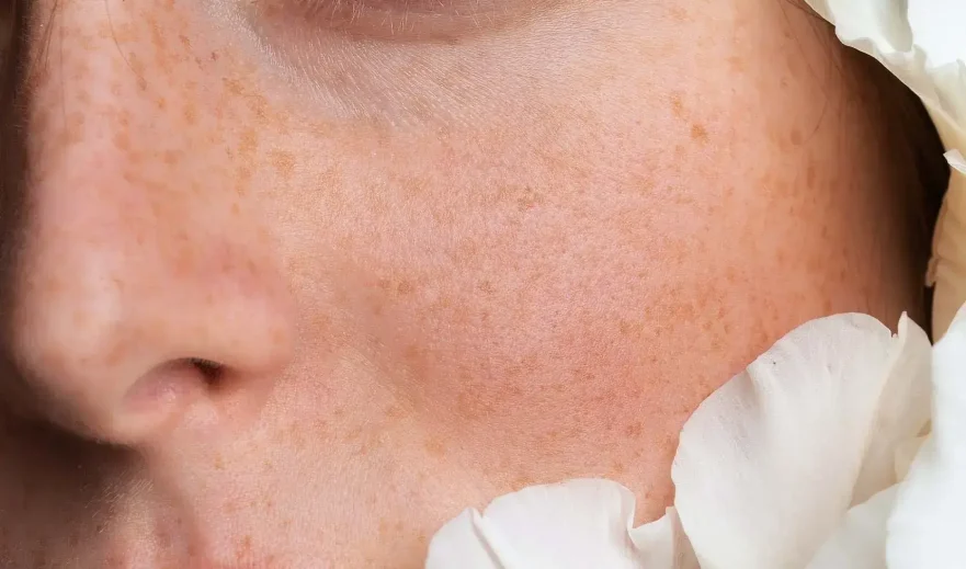 Visage de femme avec tâches de rousseur créées en maquillage permanent au salon Kanea à Toulon
