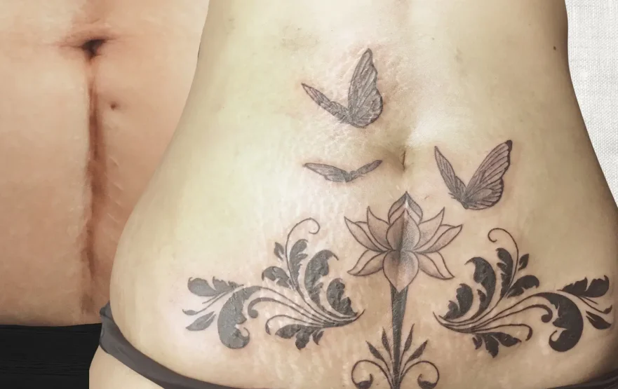 Avant après tatouage floral avec papillons et lotus pour couvrir une cicatrice du ventre au salon Kanea à Toulon