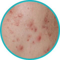 Peeling naturel sur l'acné et les imperfections — Kanea, Toulon